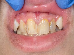 दांत पड़ गए हैं Yellow तो इन 3 चीज को मिलाकर बनाइए Teeth whitening powder दांत पड़ गए हैं Yellow तो इन 3 चीज को मिलाकर बनाइए Teeth whitening powder