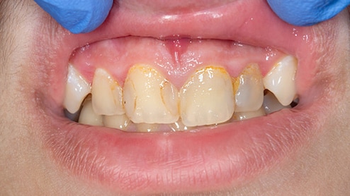 पीले दांतों को सफेद कैसे करें? एक बार जरूर अपनाएं ये घरेलू उपाय