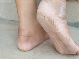फटी एड़ियों से हो चुकी हैं परेशान तो जरा आजमाकर देख लें रसोई की यह चीज, Cracked Heels एकदम हो जाएंगी गायब  फटी एड़ियों से हो चुकी हैं परेशान तो जरा आजमाकर देख लें रसोई की यह चीज, Cracked Heels एकदम हो जाएंगी गायब