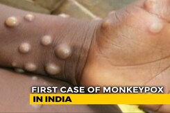 India's First Monkeypox Case In Kerala, Centre Rushes High-Level Team India's First Monkeypox Case In Kerala, Centre Rushes High-Level Team