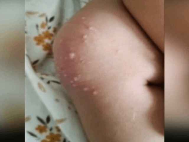 'Tomato Flu' Hits Children In Mumbai