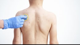 Debunking Myths About Mpox: Facts To Manage Outbreak