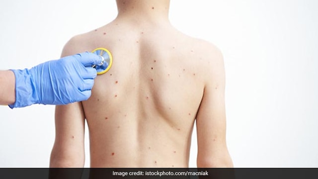Debunking Myths About Mpox: Facts To Manage Outbreak