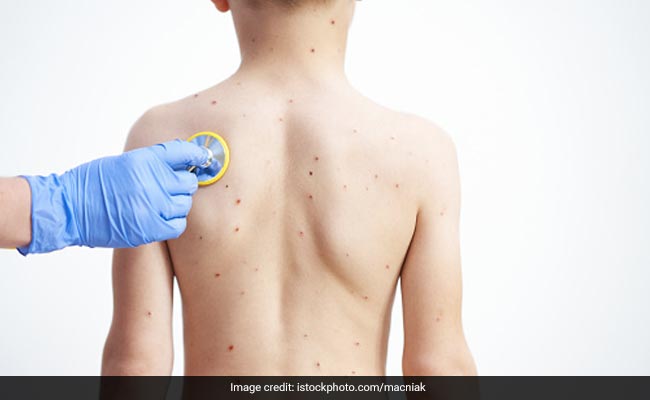 Debunking Myths About Mpox: Facts To Manage Outbreak