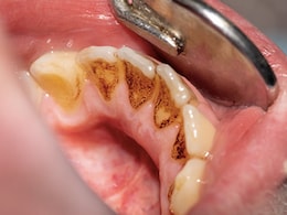 दांत पर जमा हो गई है पीली परत, खुलकर हंसने में आती है शर्म, तो अप्लाई करें ये नुस्खा, सफेद चमकदार हो जाएंगे दांत