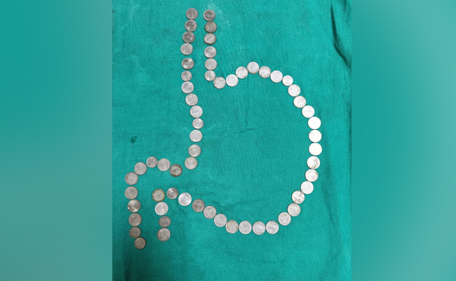 Doctors Take Out More Than 50 Coins From Rajasthan Man's Stomach Without Any Surgery