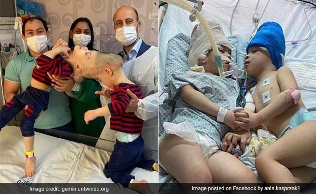 Brazilian Conjoined Twins Who Shared Fused Brains Successfully Separated