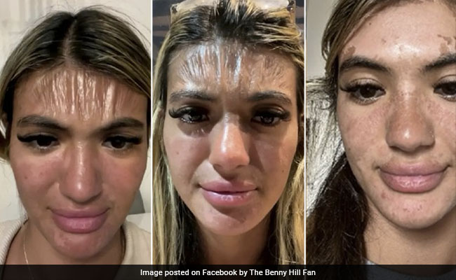 Woman Shocked To Find Forehead Skin Looking Like Plastic, Claims She Slept Under Sun