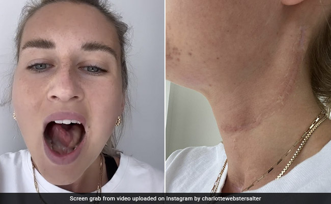 Woman Told Mouth Ulcers Were Caused By Wisdom Teeth, Had Tongue Remade After Cancer Diagnosis
