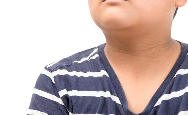 Dark pigmentation on the underarms, neck, and groin can be a sign of diabetes