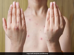 Tomato Flu बच्चों को लेने लगा है अपनी चपेट में, जानिए इसके लक्षण, बचाव और जरूरी सावधानी के बारे में Tomato Flu बच्चों को लेने लगा है अपनी चपेट में, जानिए इसके लक्षण, बचाव और जरूरी सावधानी के बारे में
