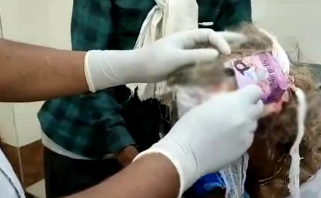 Head Wound Dressed With Condom Pack At Madhya Pradesh Health Centre