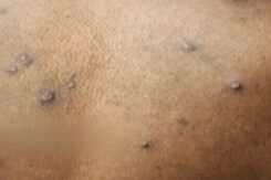 Monkeypox: Kerala Reports 5th Case, 7 In India So Far Monkeypox: Kerala Reports 5th Case, 7 In India So Far