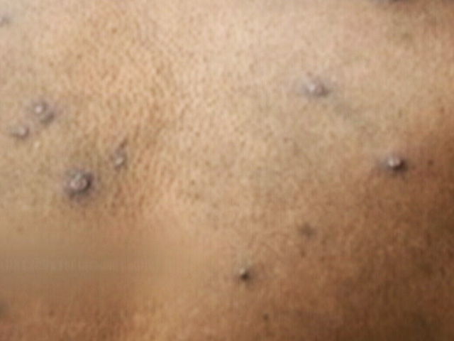 मंकीपॉक्स पर केंद्र की हाई लेवल मीटिंग, अब तक कुल 9 मामले आ चुके हैं सामने