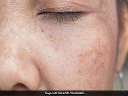 क्या आपकी भी Skin पर है ढे़र सारे दाग तो इन उपायों से करें ठीक, नहीं पड़ेगी केमिकल प्रोडक्ट की जरूरत क्या आपकी भी Skin पर है ढे़र सारे दाग तो इन उपायों से करें ठीक, नहीं पड़ेगी केमिकल प्रोडक्ट की जरूरत