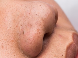 Home remedy : इन घरेलू नुस्खों से Blackheads का करें छुटकारा, यहां जानिए कैसे Home remedy : इन घरेलू नुस्खों से Blackheads का करें छुटकारा, यहां जानिए कैसे