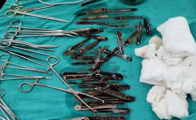 Watch: 63 Steel Spoons Removed From Man's Stomach In UP