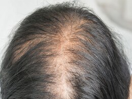 अगर आपके बाल हैं जरूरत से ज्यादा पतले, तो इन 5 बातों का रखें ख्याल, Thin Hair को मिलेगा फायदा  अगर आपके बाल हैं जरूरत से ज्यादा पतले, तो इन 5 बातों का रखें ख्याल, Thin Hair को मिलेगा फायदा