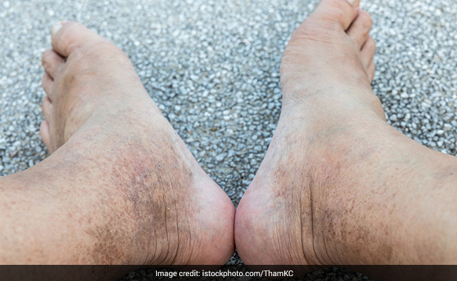 मैल जमने के कारण काले दिखने लगे हैं पैर तो लगाकर देखें ये 5 चीजें, गंदगी का चुटकियों में हो जाएगा सफाया 