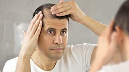 Losing Hair After Weight Loss? Experts Explain Why - 5 Diet Tips For Hair Growth