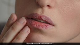 Winter Skincare: Dry Lips Due To Harsh Winter Cold? Try These Remedies For Supple Skin