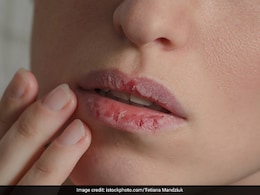 Winter Skincare: Dry Lips Due To Harsh Winter Cold? Try These Remedies For Supple Skin Winter Skincare: Dry Lips Due To Harsh Winter Cold? Try These Remedies For Supple Skin