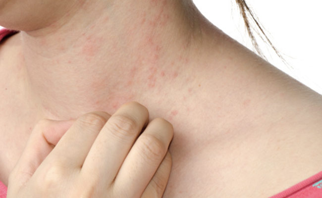 Common Summer Skin Problems: गर्मी में पसीने की खुजली कर रही है परेशान? दूर करने के लिए अपनाए ये उपाए
