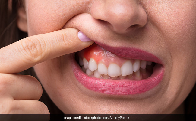Health News : आलू, प्याज, हल्दी... दांत के दर्द को दूर भगाने के लिए अपनाएं आचार्य बालकृष्ण के ये घरेलू उपाय