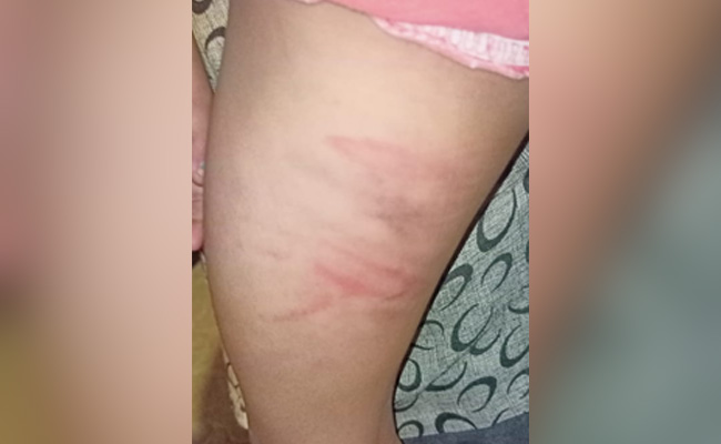 Delhi Sisters, 6 And 8, Locked In Room, Thrashed With Pipe By Tutor