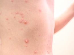 Tomato Flu से बचने के लिए केंद्र ने जारी की एडवाइजरी, जानें सावधानी से जुड़ी कुछ जरूरी बातें  Tomato Flu से बचने के लिए केंद्र ने जारी की एडवाइजरी, जानें सावधानी से जुड़ी कुछ जरूरी बातें
