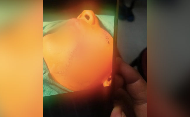 Video: 11-Year-Old Attacked By Pit Bull, 200 Stitches On His Face