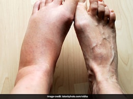 पैरों की सूजन से छुटकारा दिलाने वाले कारगर घरेलू उपाय, जल्द ही आपको महसूस होगी राहत