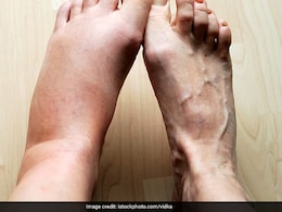 पैरों में अक्सर सूजन आना किस बीमारी का है संकेत? जानकर आप भी रह जाएंगे हैरान पैरों में अक्सर सूजन आना किस बीमारी का है संकेत? जानकर आप भी रह जाएंगे हैरान
