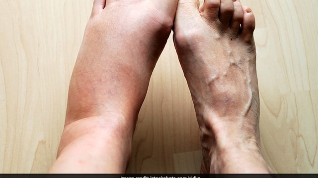Certain medications can cause swelling as a side effect