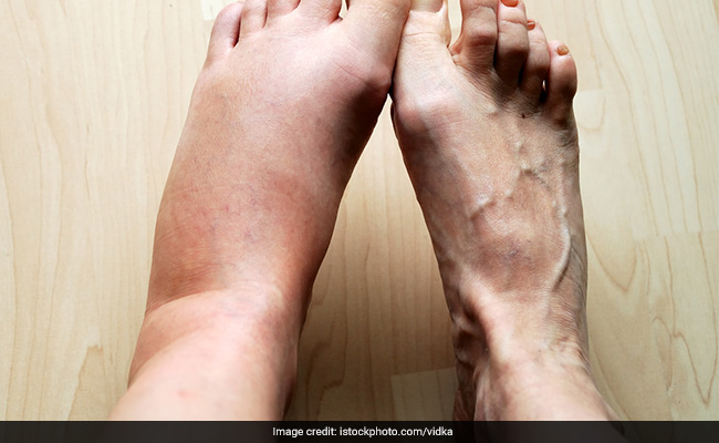 Certain medications can cause swelling as a side effect
