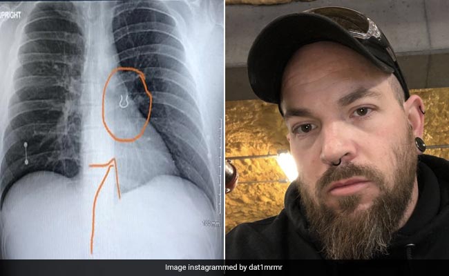 Man Lost Nose Ring 5 Years Ago. It Was Found In His Lung