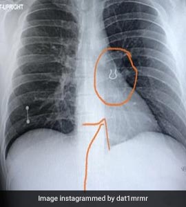 सांस के साथ फेफड़ों तक चली गई नोज़ पिन, एक्स-रे देख डॉक्टर के उड़े होश, मसां-मसां बची जान