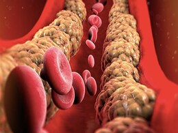 नसों में जमा कॉलेस्ट्रोल हो सकता है जानलेवा, इस Cholesterol को पिघलाने के लिए डाइट में शामिल करें ये 5 फूड नसों में जमा कॉलेस्ट्रोल हो सकता है जानलेवा, इस Cholesterol को पिघलाने के लिए डाइट में शामिल करें ये 5 फूड