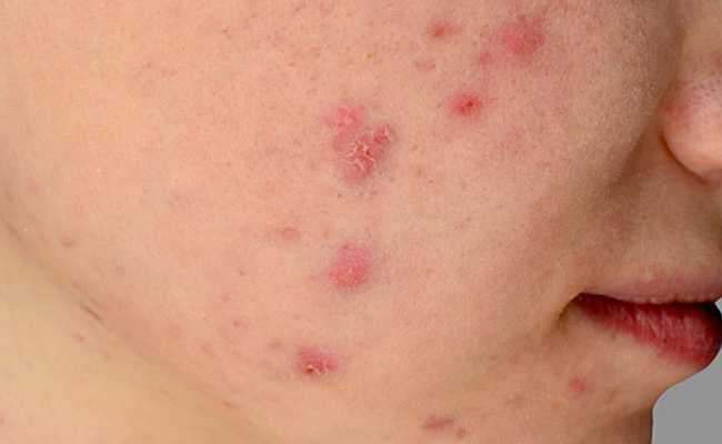 Skincare Tips: Sick Of Stubborn Pimple Marks? Try These Herbal Remedies For Relief