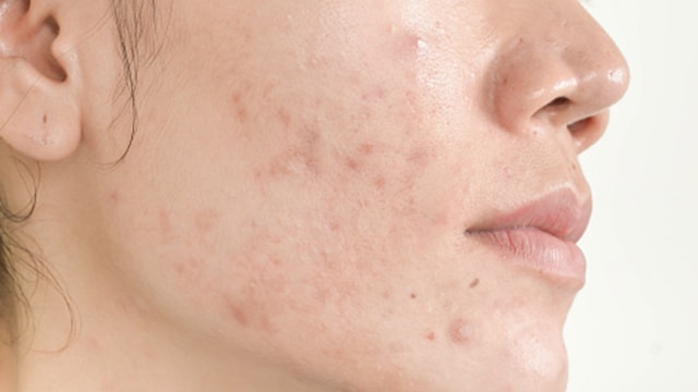 Nutritionist Links Dull Skin To Liver Health, Recommends Everyday Foods For Detox Support