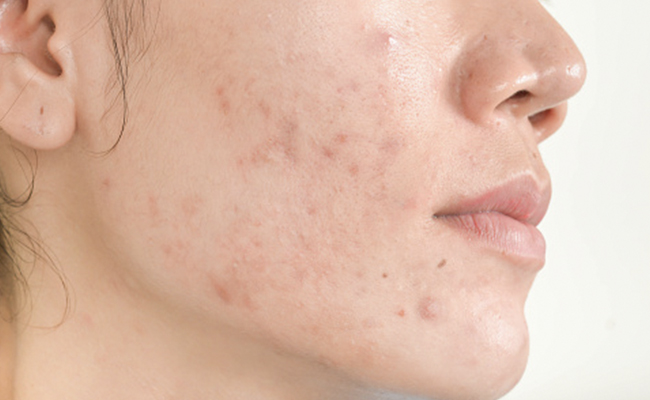 Nutritionist Links Dull Skin To Liver Health, Recommends Everyday Foods For Detox Support