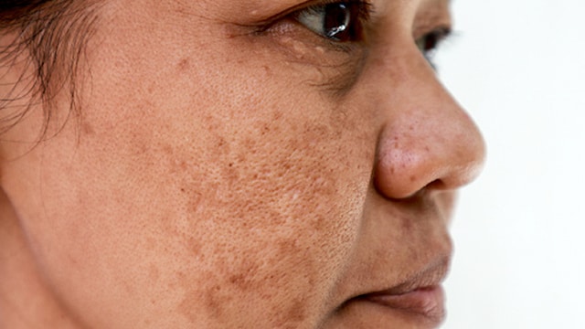 By following these tips individuals with hyperpigmentation can effectively manage their condition