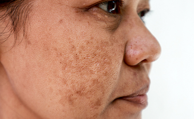 By following these tips individuals with hyperpigmentation can effectively manage their condition