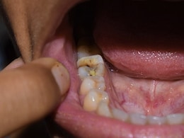 Toothache Remedies: दांत के दर्द से तुरंत राहत कैसे पाएं? दांत दर्द, दांतों का पीलापन और दांत के कीड़े से छुटकारा पाने के आसान नुस्खे Toothache Remedies: दांत के दर्द से तुरंत राहत कैसे पाएं? दांत दर्द, दांतों का पीलापन और दांत के कीड़े से छुटकारा पाने के आसान नुस्खे