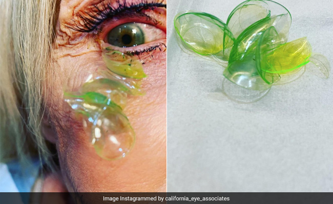Shocking Video Shows Doctor Removing 23 Contact Lenses From Patient's Eye Who "Forgot" To Take Them Off