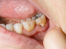 दांतों में दिखने लगी है सड़न तो ये 5 चीजें आएंगी आपके काम, Tooth Cavity बढ़ने से रुक जाएगी  दांतों में दिखने लगी है सड़न तो ये 5 चीजें आएंगी आपके काम, Tooth Cavity बढ़ने से रुक जाएगी