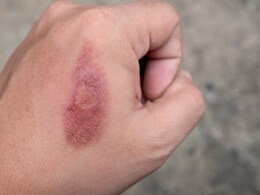 Burn First aid: जलने पर कब जरूरी होता है फर्स्ट एड? जानिए जलने पर सबसे पहले क्या करें और क्या नहीं Burn First aid: जलने पर कब जरूरी होता है फर्स्ट एड? जानिए जलने पर सबसे पहले क्या करें और क्या नहीं