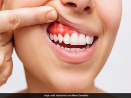 मसूड़ों में महसूस होती है जलन तो आजमाकर देंखें ये 5 उपाय, Gums का दर्द होगा कम और महसूस होने लगेगी राहत  मसूड़ों में महसूस होती है जलन तो आजमाकर देंखें ये 5 उपाय, Gums का दर्द होगा कम और महसूस होने लगेगी राहत