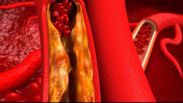 A healthy diet and lifestyle can help maintain cholesterol levels