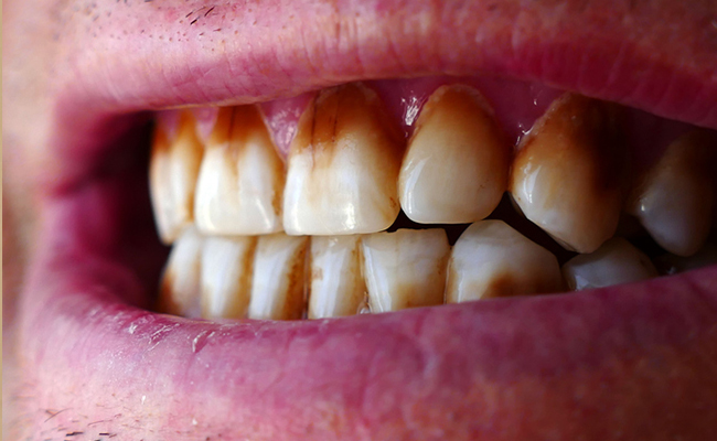 पीले से पीले दांतों को साफ करने में असरदार है ये Teeth Whitening Powder, जान लीजिए बनाने का तरीका